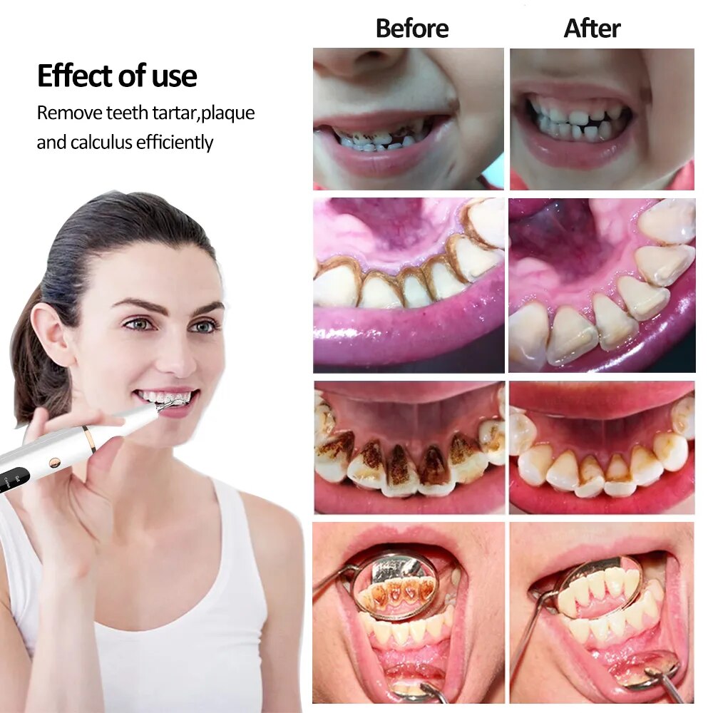Electric Dental Calculus Remover - Wholesalus