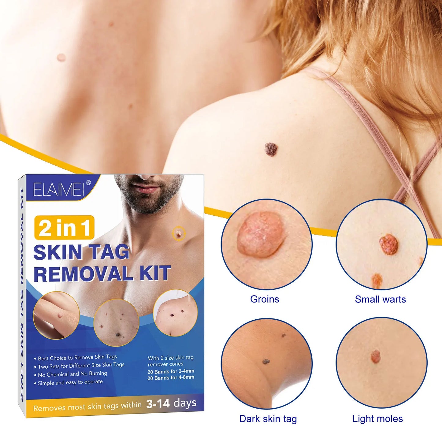 Skin Tag Removal Kit - Wholesalus