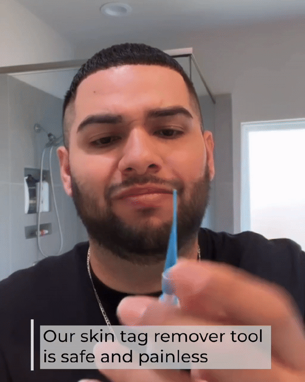 Skin Tag Removal Kit - Wholesalus