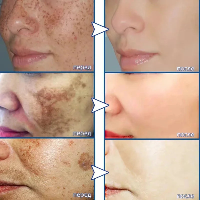 Moisturizing Dark Spots Remover - Wholesalus