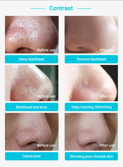 Nose Pore Strip Blackhead Remover - Wholesalus