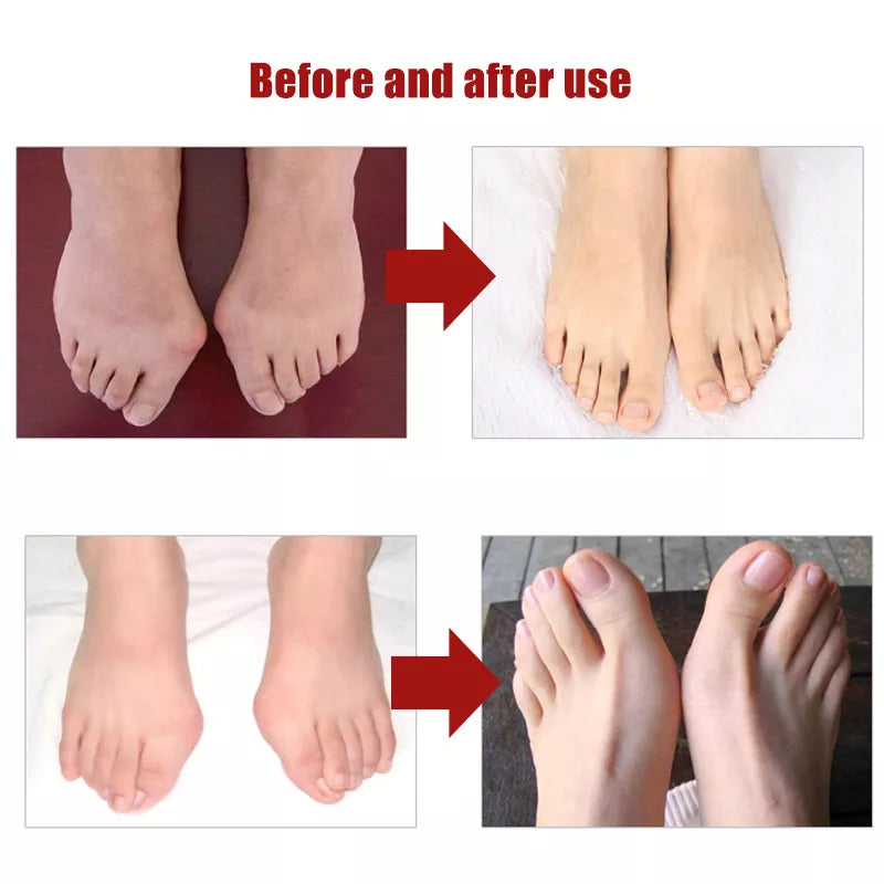 Silicone Toes Valgus Corrector