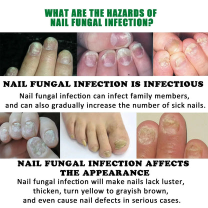 Nail Fungus Defender Serum - Wholesalus