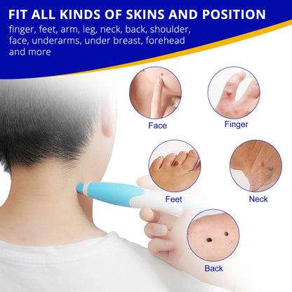 Skin Tag Removal Kit - Wholesalus