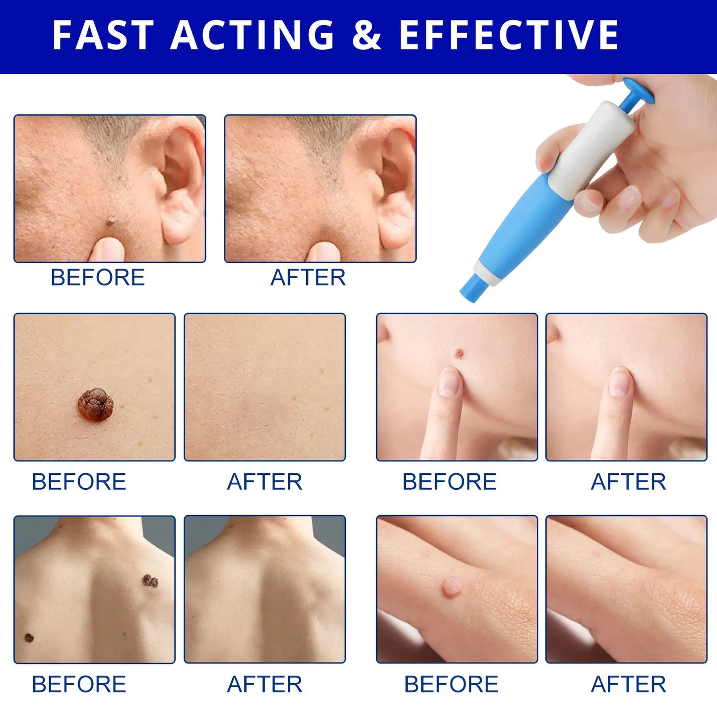 Skin Tag Removal Kit