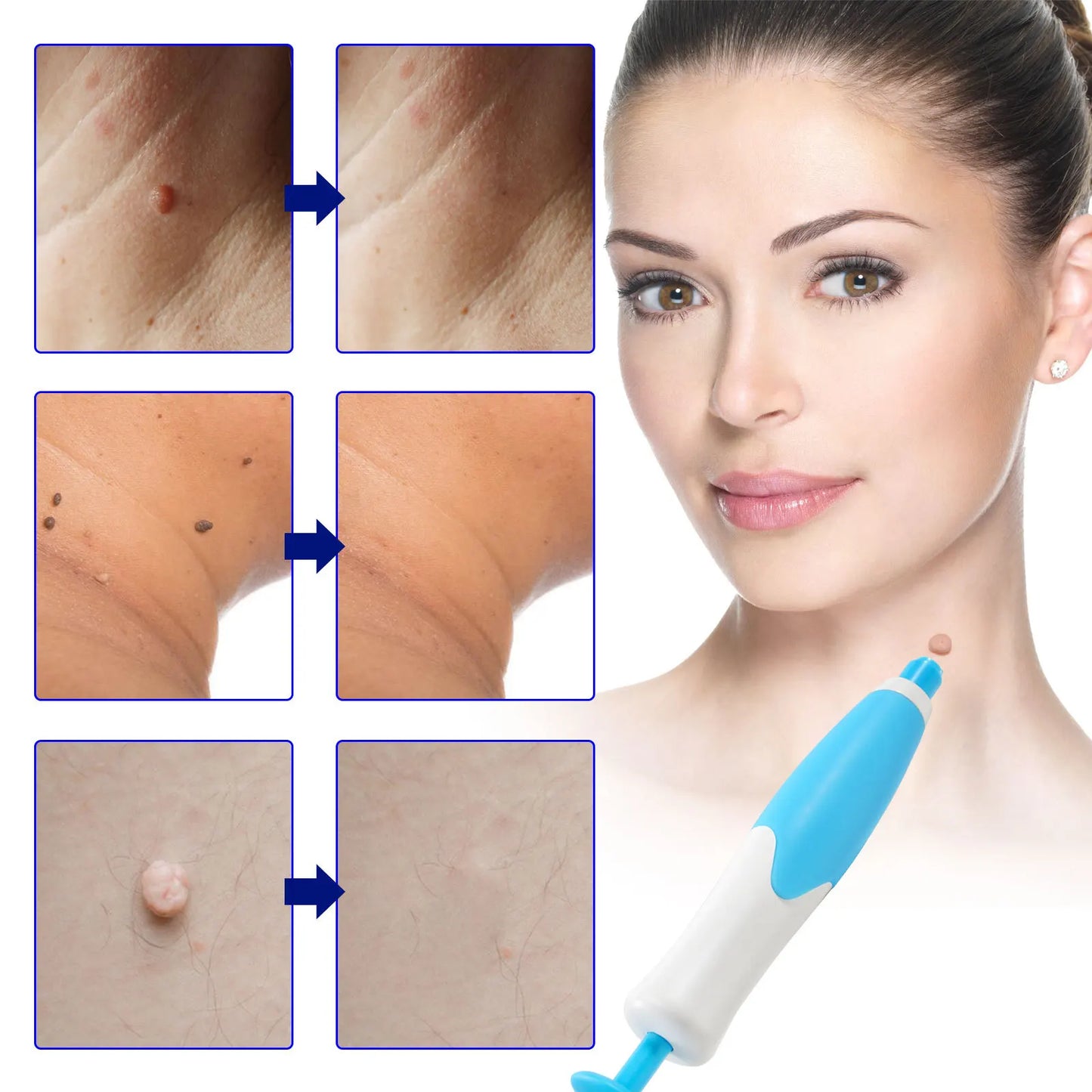 Skin Tag Removal Kit