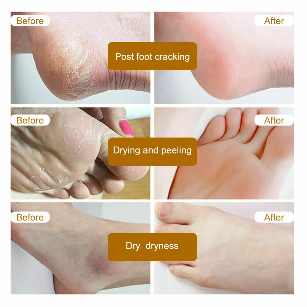 Dead Skin Remover Crack Cream - Wholesalus