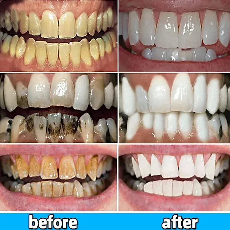 Dental Calculus Removing Toothpaste