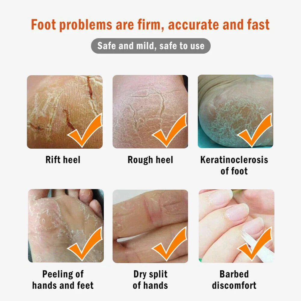 Dead Skin Remover Crack Cream - Wholesalus