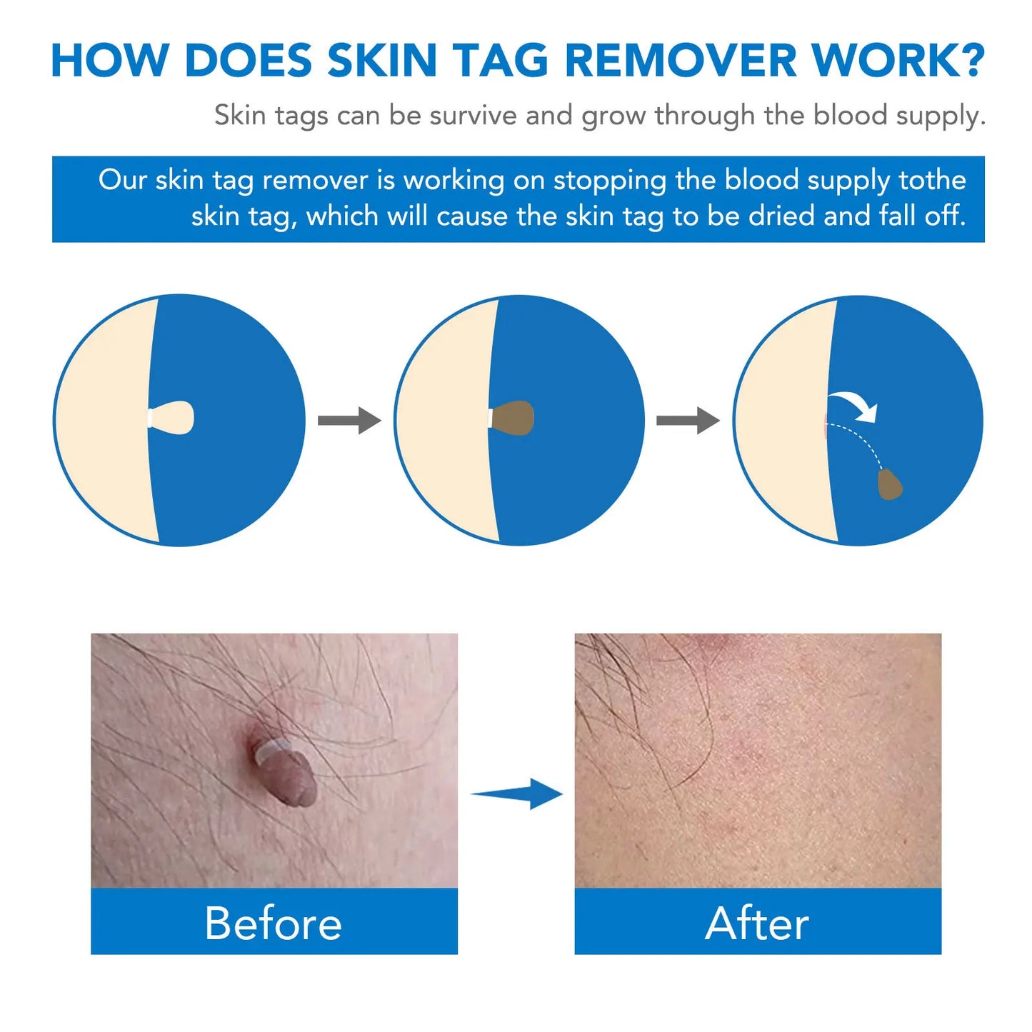 Skin Tag Removal Kit