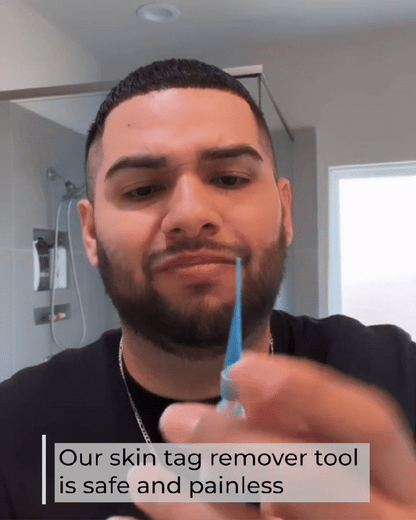 Skin Tag Removal Kit - Wholesalus
