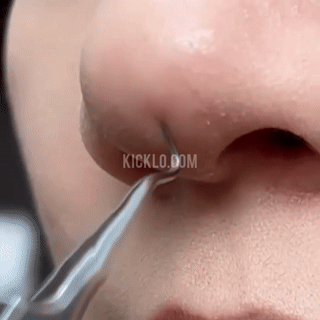 Stainless Steel Blackhead Remover Tool - 3Pcs Set - Wholesalus